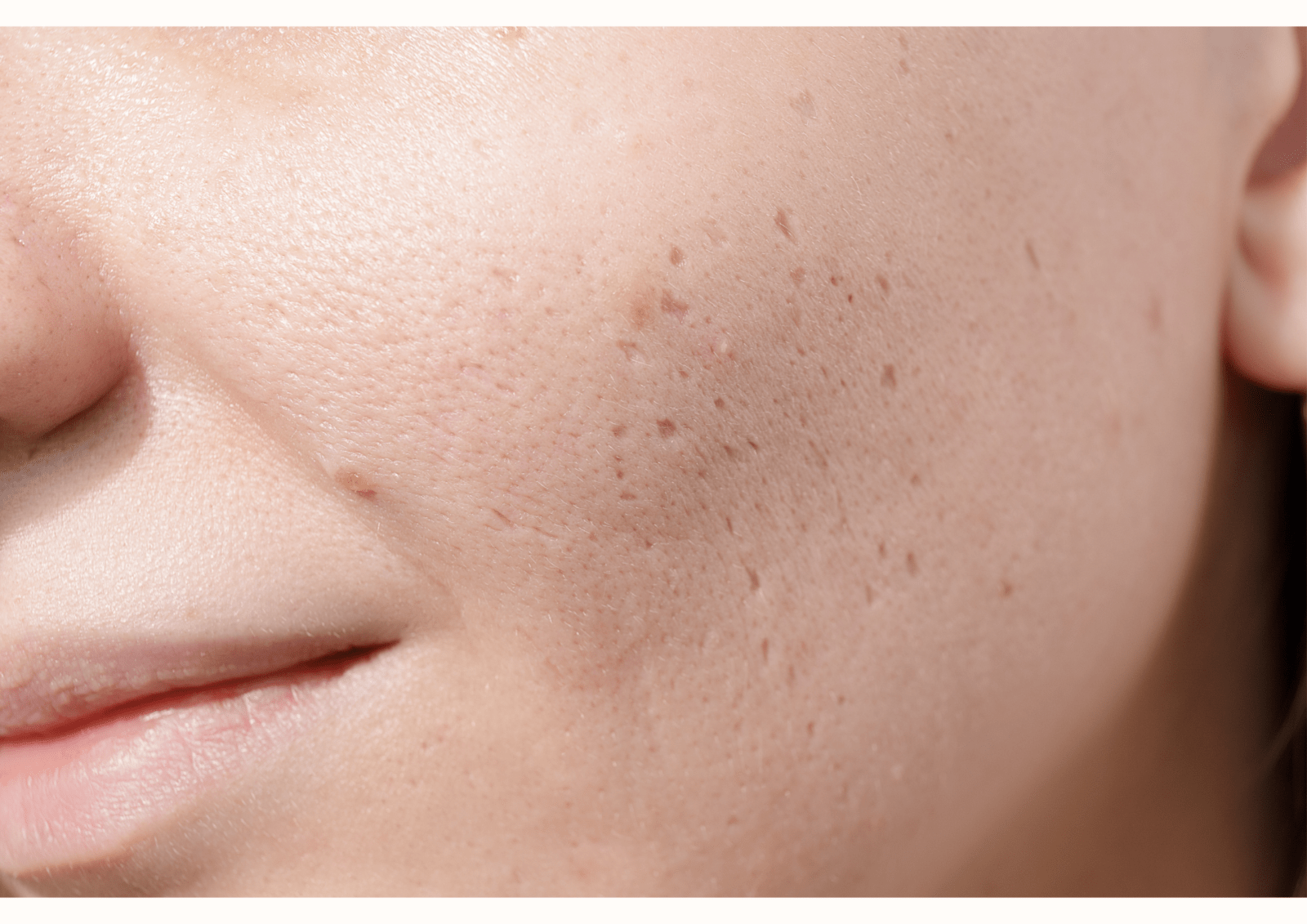 Postacne Narben